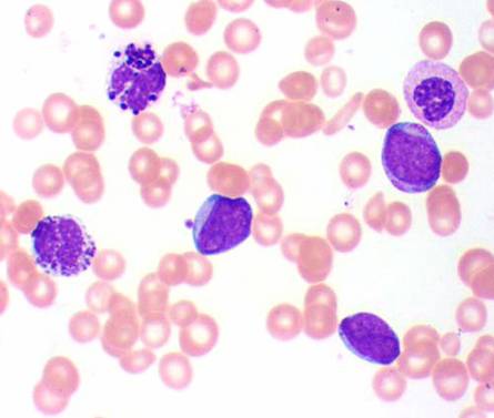 CML in the blood