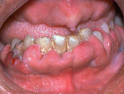 Hyperplasia in gums