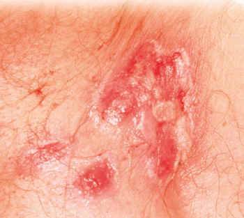 Skin lesions